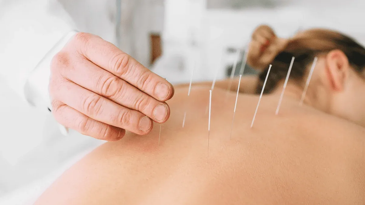 Acupuntura: 15 Benefícios para a Saúde