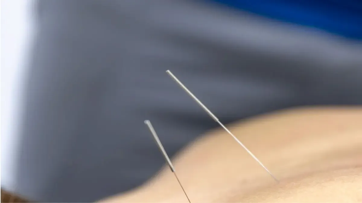 Acupuntura benefícios e malefícios