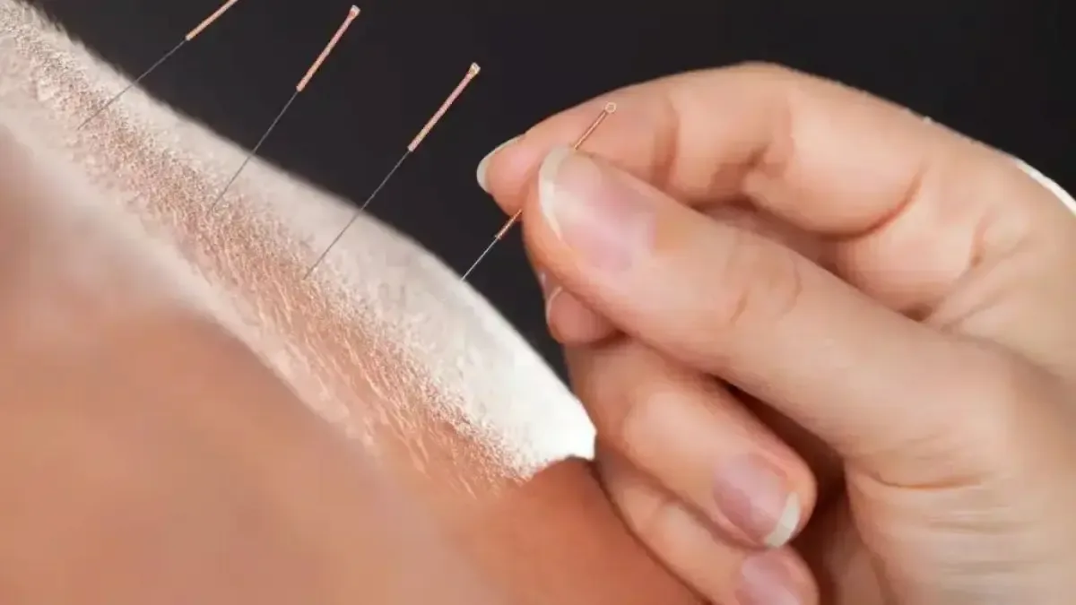 Acupuntura dói