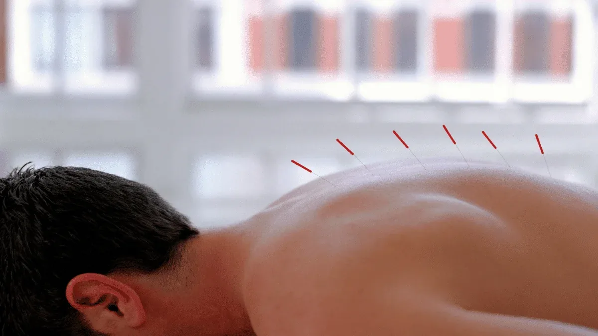 Acupuntura é indicada para quais casos?