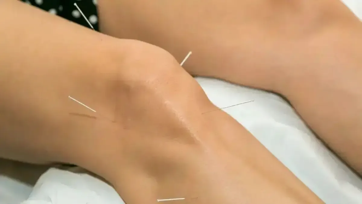 Acupuntura no joelho