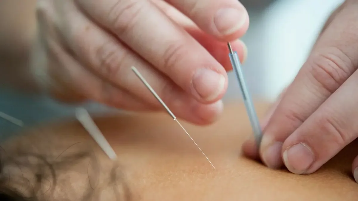 Acupuntura: o que pode curar