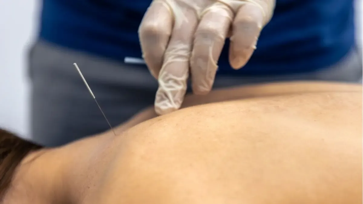 Acupuntura para coluna é segura