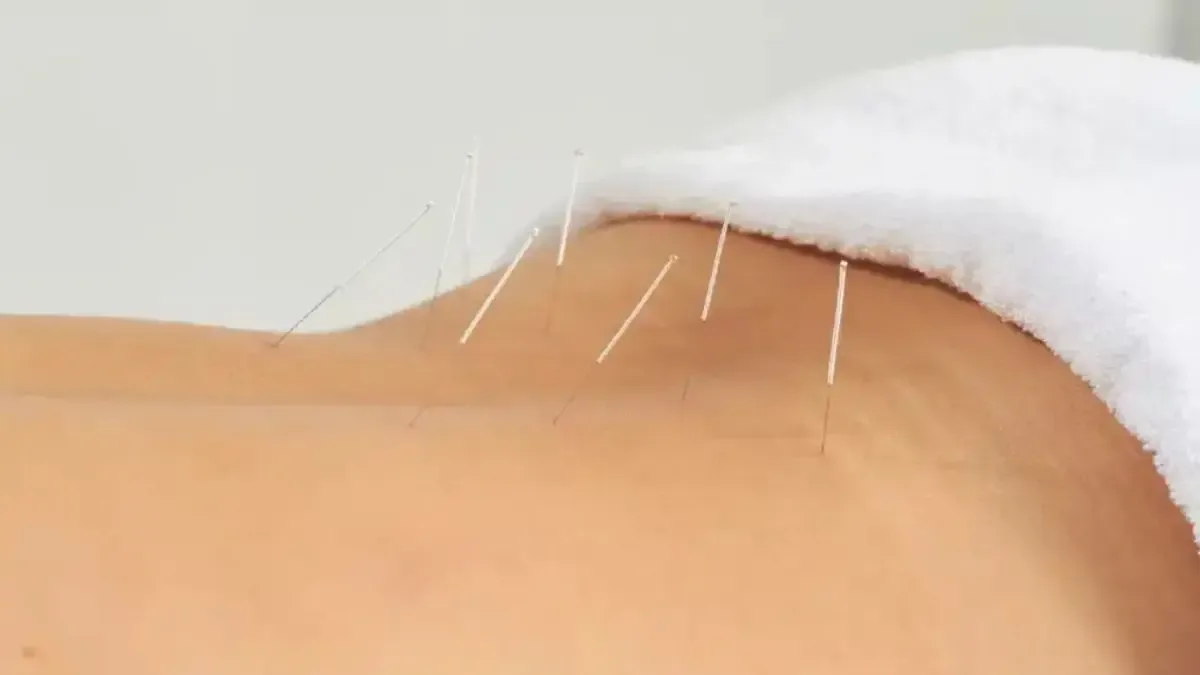 Acupuntura para nervo ciático