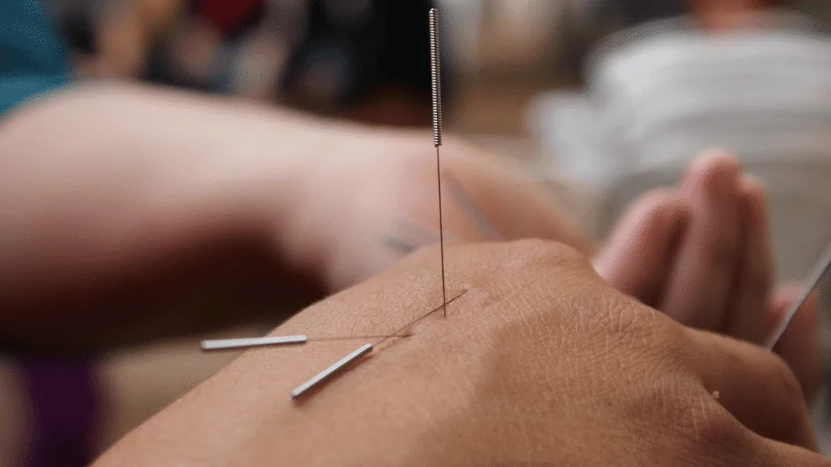 Acupuntura: Vantagens e Desvantagens