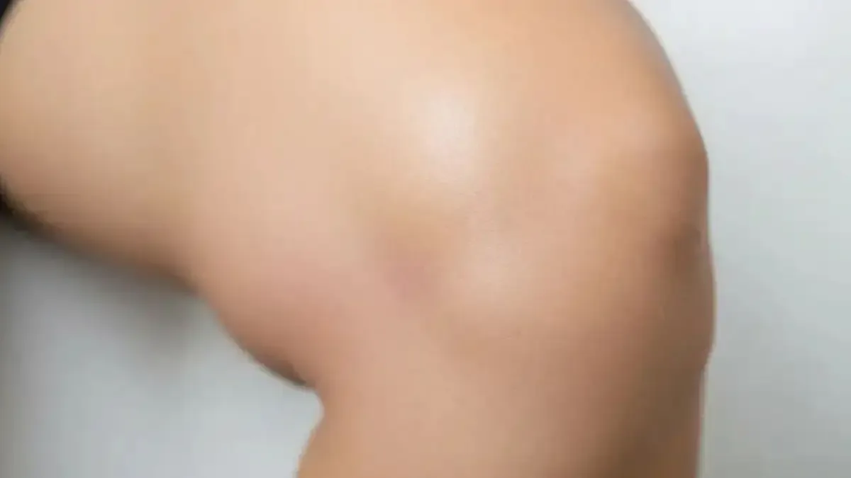 Derrame articular com sinais de sinovite