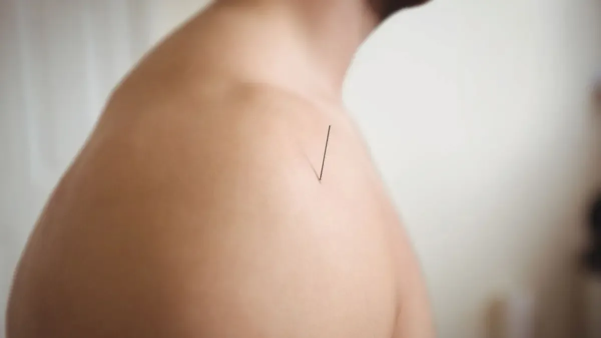O que não pode fazer depois da acupuntura