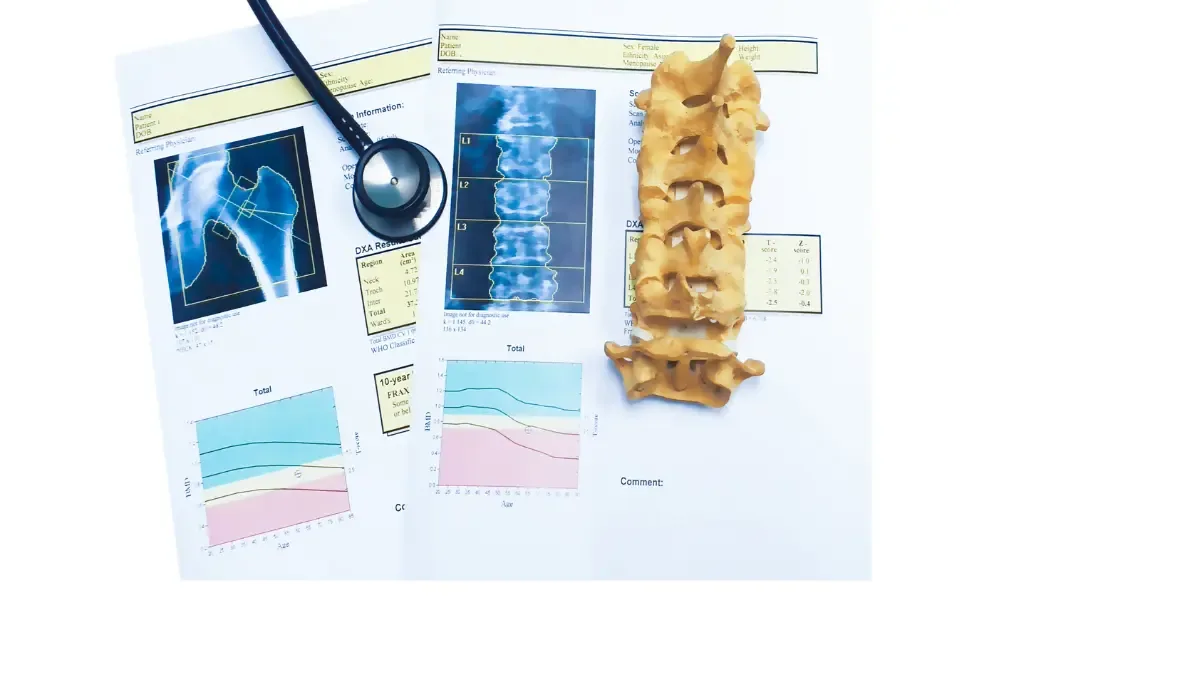 Osteopenia: O Que É, Sintomas e Tratamentos Recomendados