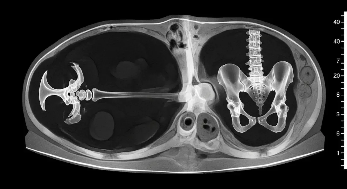 Osteoporose transitória do quadril