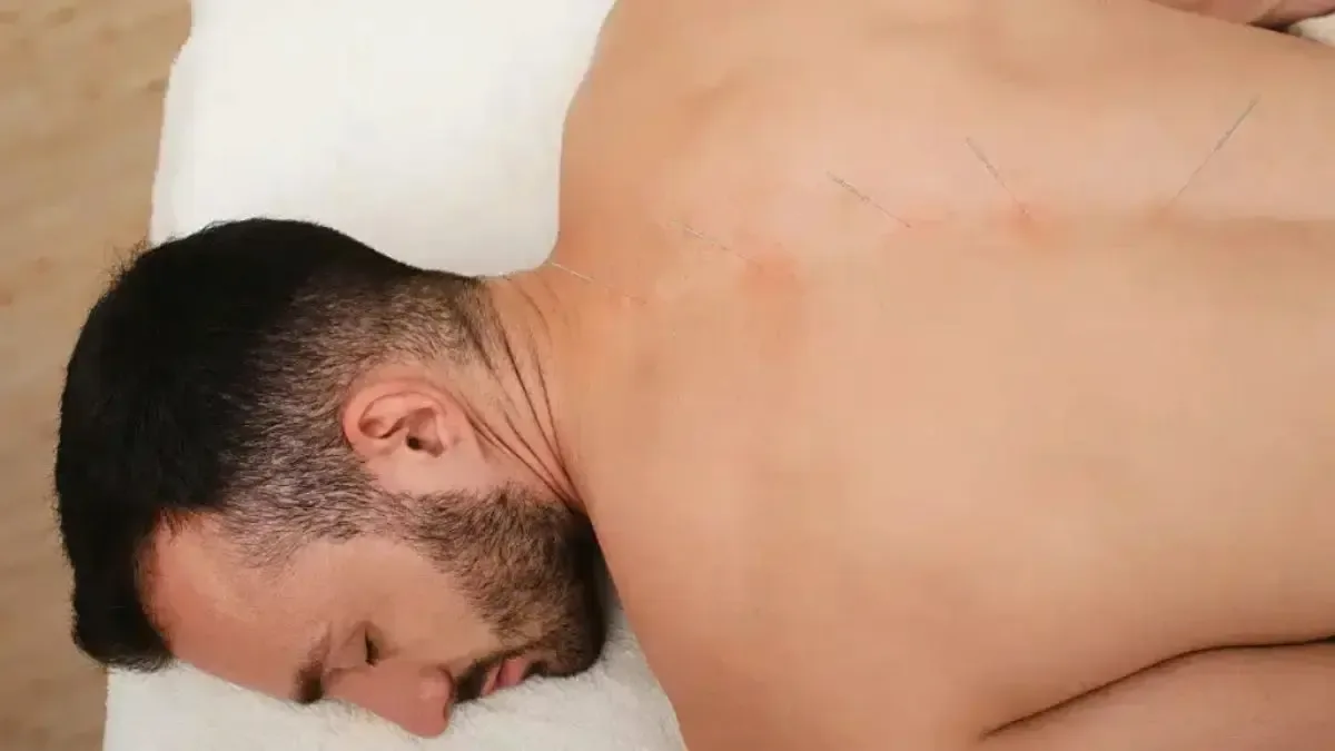 Para que serve acupuntura na coluna