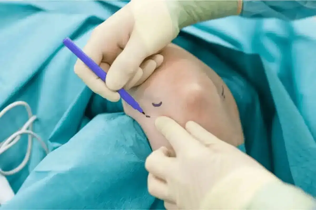 Quanto tempo dura cirurgia cotovelo: Fatores que influenciam!
