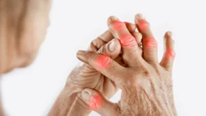 Osteoartrite da mão